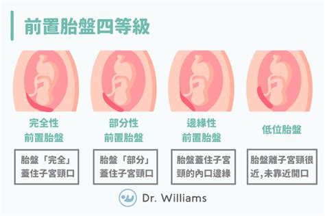 胎盤前置|前置胎盤一點也不可怕！讓醫師教妳平時怎麼做！ 